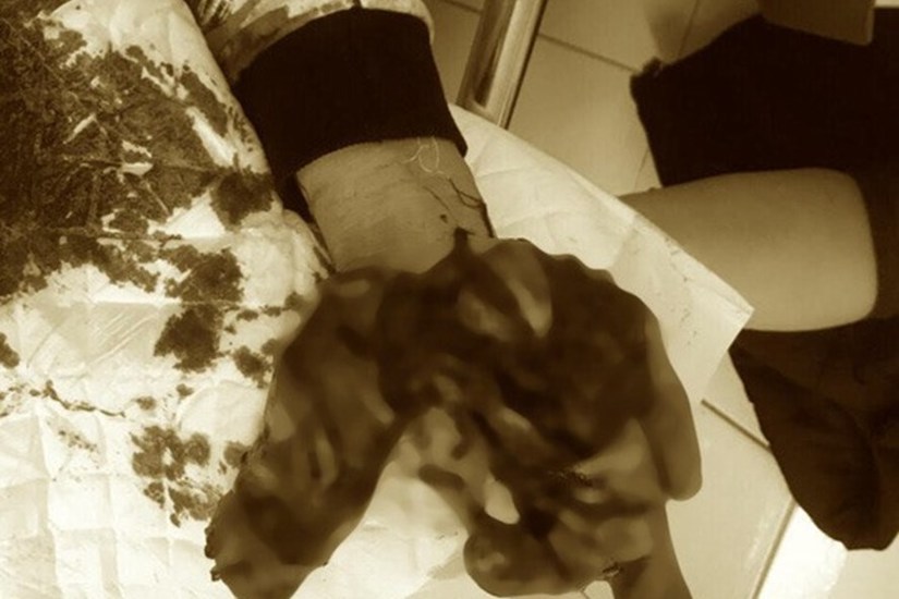 Cậu bé Nam Định bị dập nát bàn tay vì nghịch thuốc pháo tự chế