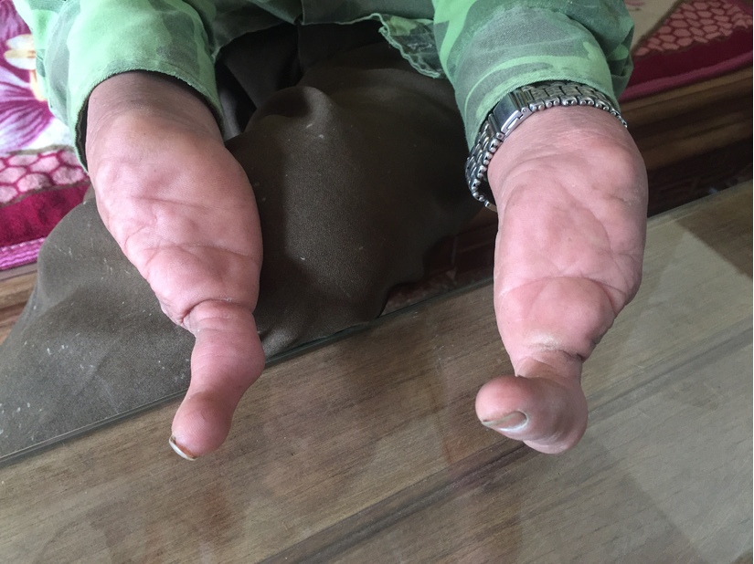 Gia đình kỳ lạ, chỉ có một ngón tay, ngón chân ở Hà Nam
