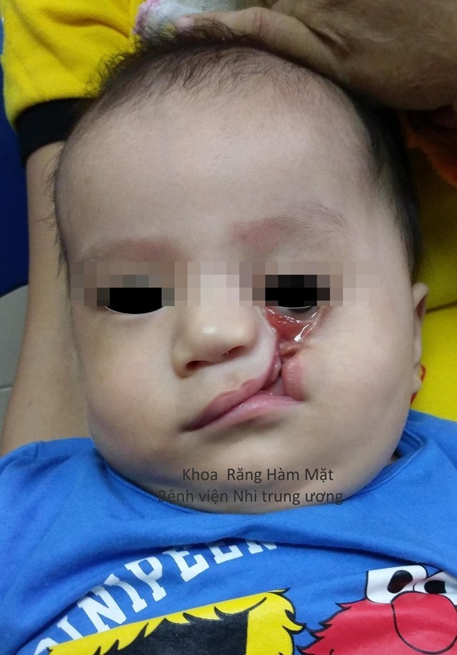 Bé trai 8 tháng ở Hà Tĩnh mắc bệnh hiếm khiến mặt biến dạng, nước mắt liên tục chảy tràn