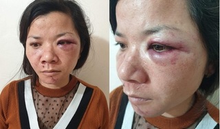 Nam Định: Vợ bị chồng đánh đập dã man vào tối mùng 2 Tết?
