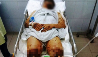 Về quê ăn Tết, một Việt kiều bị tạt axit, cắt gân chân dã man