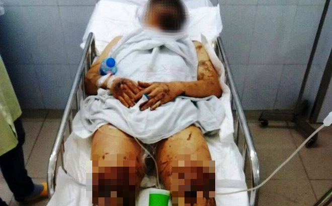 Việt kiều bị tạt axit, cắt gân chân được chuyên cơ chở qua Canada điều