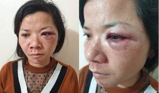 Tâm sự đẫm nước mắt của người phụ nữ bị chồng đánh dã man vào tối mùng 2 Tết