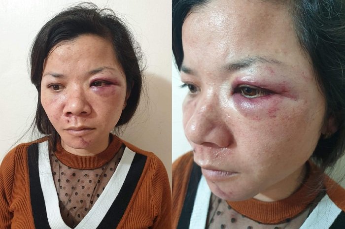 Vợ bị chồng đánh thâm tím mắt ở Nam Định hôm mùng 2 Tết