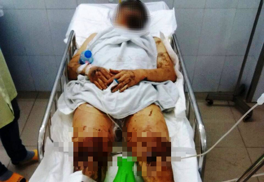 Tình hình sức khỏe của Việt kiều bị tạt axit, cắt gân chân ở Quảng Ngãi
