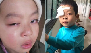 Lạng Sơn: Điều tra học sinh tiểu học bị chấn thương mắt nghi do cô giáo đánh