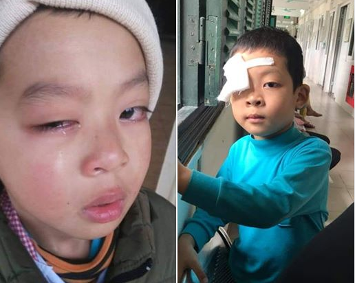 Lạng Sơn: Điều tra nghi vấn học sinh tiểu học bị chấn thương mắt do bị cô giáo đánh