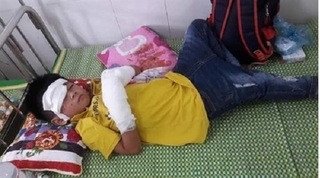 Nghệ An: Bé trai 7 tuổi bị điện thoại nổ dập nát 2 bàn tay