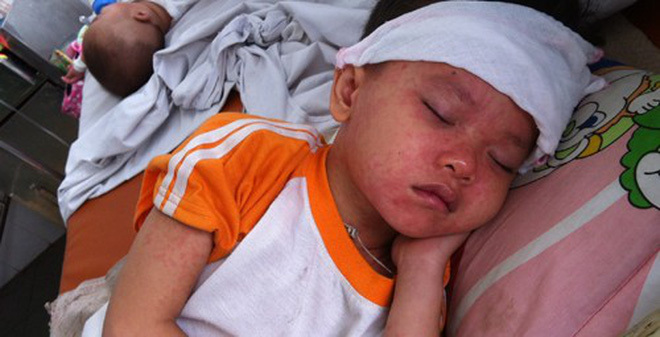 Những triệu chứng giúp phát hiện bệnh sởi sớm, phân biệt sởi với sốt phát ban