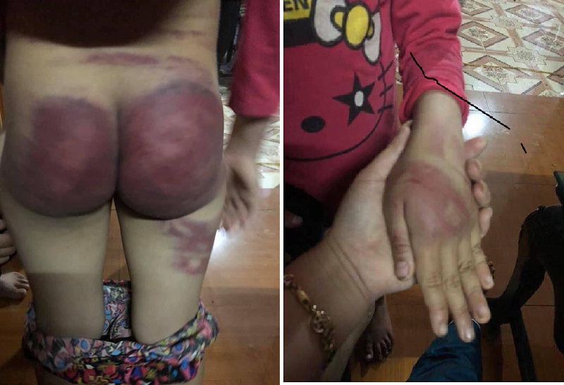 Bé gái 8 tuổi bị bố đánh bầm tím mông ở Thanh Hóa