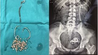 Cô gái trẻ bị bác sĩ bỏ quên stent trong niệu quản suốt 5 năm
