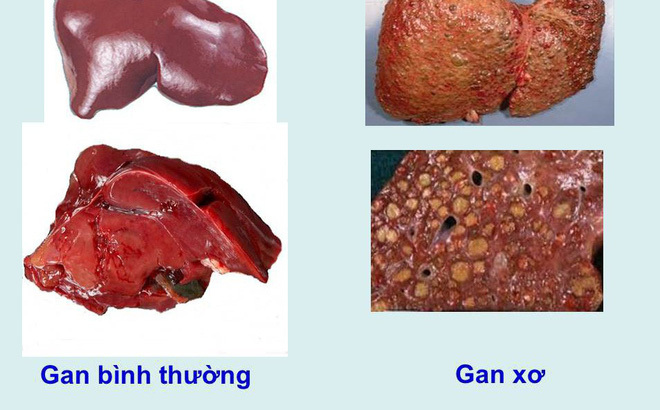 Râu ngô, đậu đỏ, bí đao trị xơ gan cổ trướng hiệu quả bất ngờ