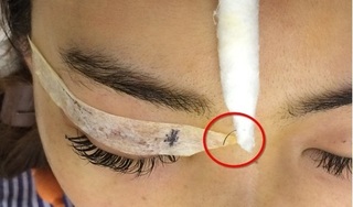 Thiếu nữ ở Hà Nội đi nhấn mí bị nhấn... cả kim khâu vào mắt