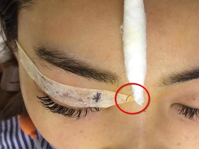 Thiếu nữ ở Hà Nội đi nhấn mí bị nhấn... cả kim khâu vào mắt