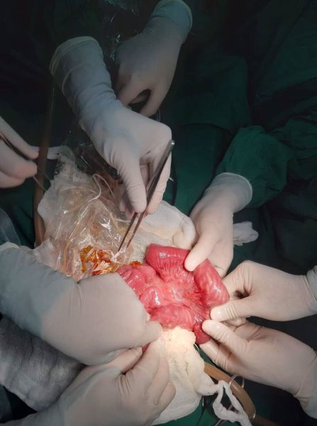 Bác sĩ tá hỏa phát hiện nửa kg giun trong bụng cháu bé 3 tuổi