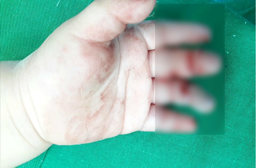 Nghệ An: Bé 16 tháng tuổi bị máy xay thịt nghiền nát bàn tay