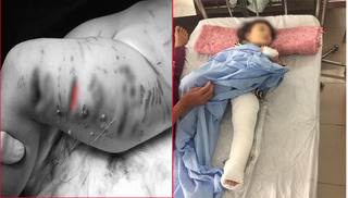  Bé gái 2 tuổi bị chó Pibull tấn công dã man, người dân phải dùng xà beng giải cứu 