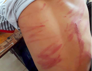 Vụ bố đánh con nhập viện ở Hà Tĩnh: Cháu bé có 79 vết thương trên cơ thể