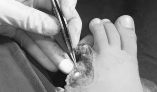Ngón chân bé 6 tuổi bị cắt đứt rời bởi “lưỡi gió” xe Air Blade