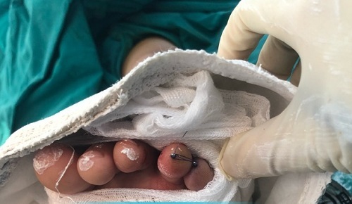 Ngón chân bé 6 tuổi bị cắt đứt rời bởi lưỡi gió xe Air Blade 2