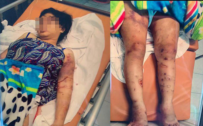 Thai phụ bị tra tấn đến sẩy thai: 'Chúng dùng keo nấu chảy, bình gas có khò gí vào người tôi'