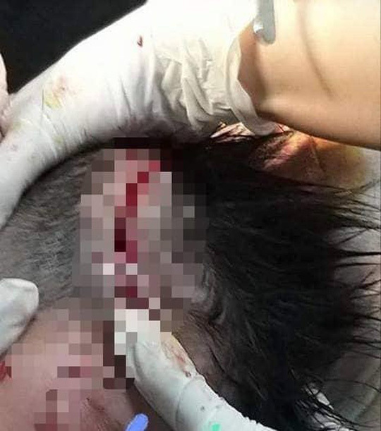 Hà Tĩnh: Bé trai 4 tuổi bị chó becgie nhà cắn xé rách da đầu