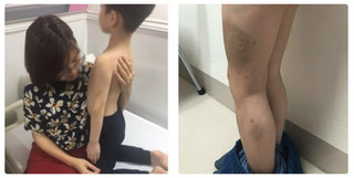 Hà Nội: Bé trai 6 tuổi nghi bị mẹ kế đánh đập thâm tím người?
