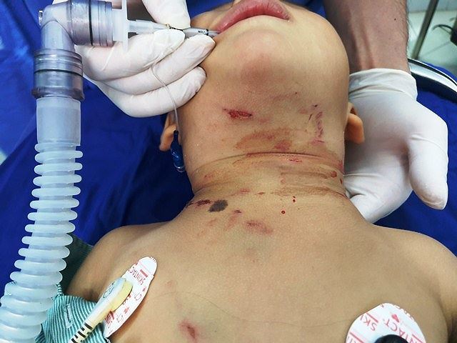 Bé trai 3 tuổi bị chó đẻ hàng xóm cắn chảy máu cổ