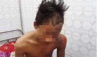 Thanh Hoá: Nam sinh lớp 10 thoát chết kỳ diệu khi bị sét đánh