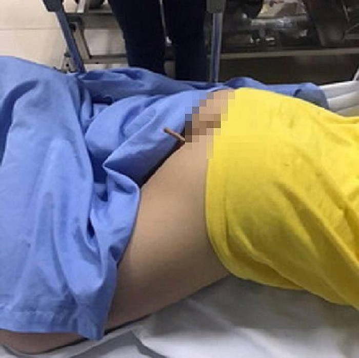 Hà Nội: Bé trai lớp 4 nhập viện cấp cứu vì bị bút chì đâm xuyên mông
