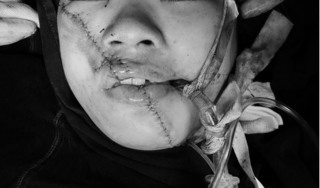 Gương mặt cô gái trẻ bị vỡ làm đôi sau tai nạn kinh hoàng