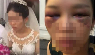 Sự thật bức ảnh cô dâu bị đánh thâm mặt vì cự tuyệt hôn chú rể trong đám cưới