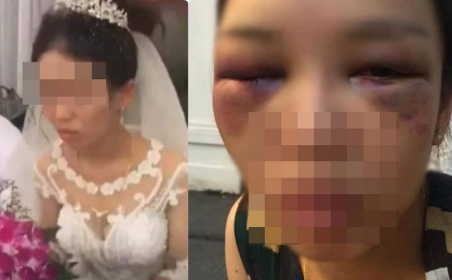 Sự thật bức ảnh cô dâu bị đánh thâm mặt vì cự tuyệt hôn chú rể trong đ