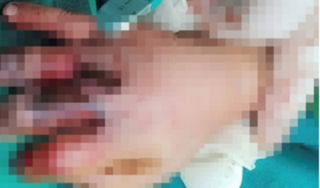Nghệ An: Bé trai bị máy ép mía kẹp dập nát bàn tay 