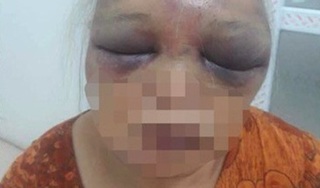 Hà Nội: Mẹ vợ bị con rể cũ đánh dã man lúc rạng sáng