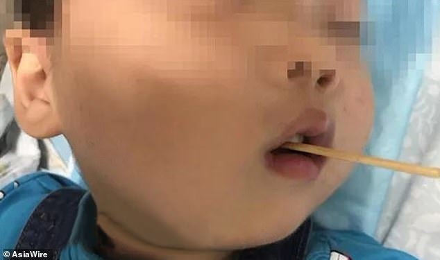 Bị que xiên xúc xích dài 10cm đâm vào não, bé trai 3 tuổi sống sót thần kỳ