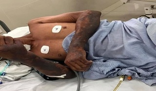 Người đàn ông tử vong sau khi ăn tiết canh, lòng lợn