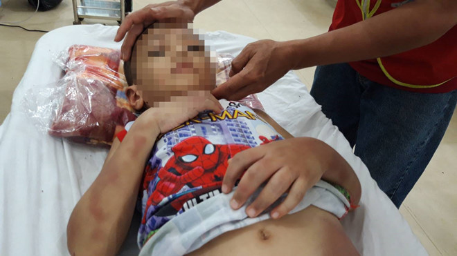 Bé trai 6 tuổi nghi bị mẹ và bạn cùng bạo hành dã man đến đa chấn thương