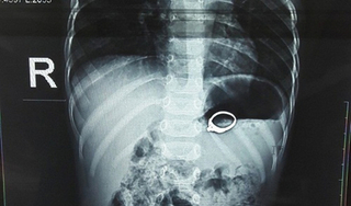 Nuốt cả chiếc nhẫn vào bụng, bé 13 tuổi ở Nghệ An bị xung huyết dạ dày