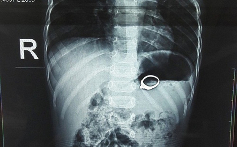 Nghệ An: Nuốt cả chiếc nhẫn vào bụng, bé 13 tuổ bị xung huyết dạ dày