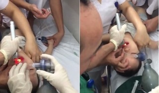 Bé trai 2 tuổi ngưng tim, ngưng thở vì hóc thạch, bác sĩ cảnh báo nguy hiểm khôn lường