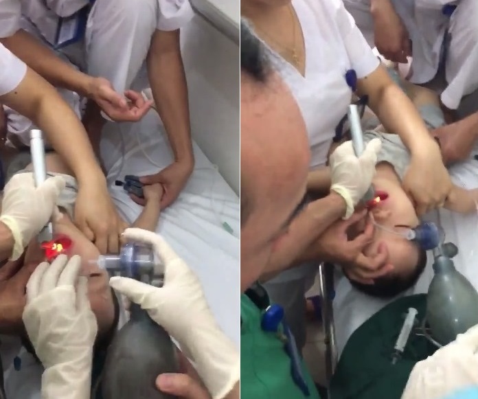 Bé trai 2 tuổi ngưng tim, ngưng thở vì hóc thạch, bác sĩ cảnh báo nguy hiểm khôn lường
