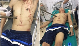Tai nạn hy hữu khiến người đàn ông Quảng Ninh bị cây cọc xuyên thấu bụng