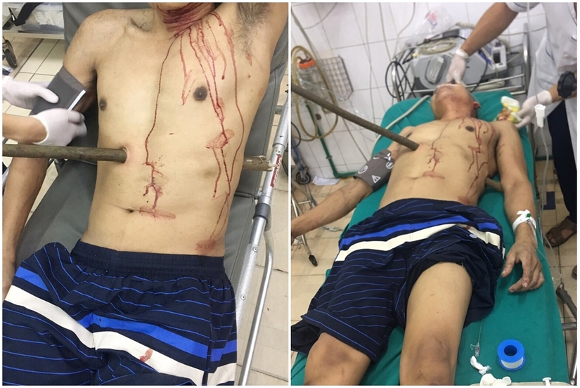 Tai nạn hy hữu khiến người đàn ông Quảng Ninh bị cây cọc xuyên thấu bụng