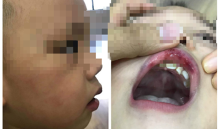 Hà Nội: Bé trai hơn 2 tuổi bị cô giáo tát bầm mặt, tụ máu môi