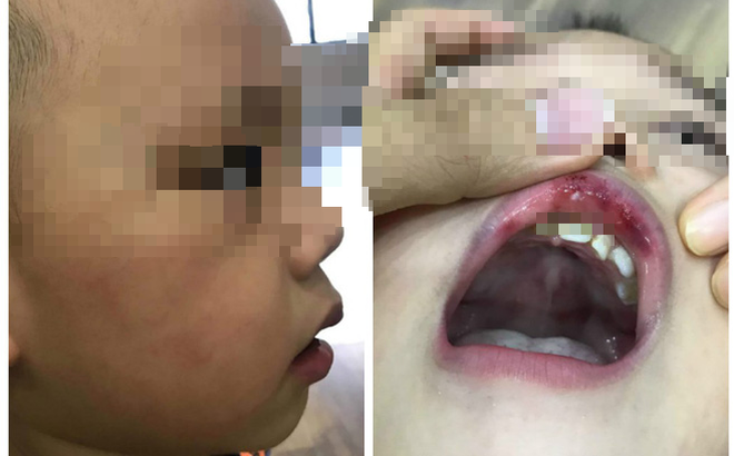 Hà Nội: Bé trai hơn 2 tuổi bị cô giáo tát bầm mặt, tụ máu môi