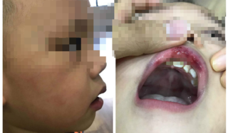 Thông tin mới nhất vụ bé trai bị cô giáo đánh bầm mặt, tím môi