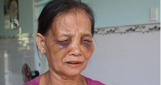 Mẹ chồng bị nàng dâu đánh bầm tím mặt mày chỉ vì... cái bô