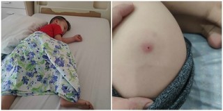Tự nặn nhọt cho con, mẹ trẻ khiến con phải nhập viện khẩn cấp
