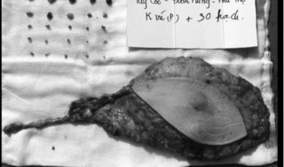 Sờ thấy u cục nhưng 1 năm sau mới đi khám, người phụ nữ phải cắt cả tuyến vú